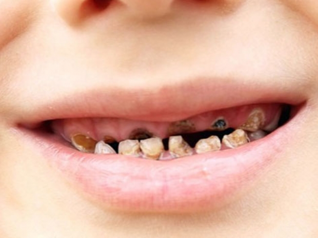 Çocuklarda ağız ve diş sağlığı nasıl olmalı